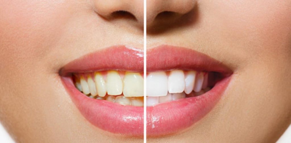 Hábitos que manchan tus dientes