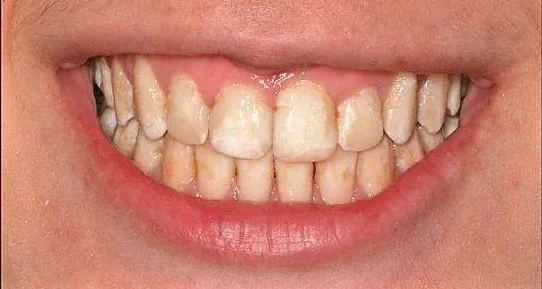 Hábitos que manchan tus dientes sucios