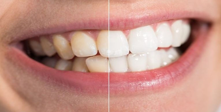 limpiar tus dientes después de vino tinto
