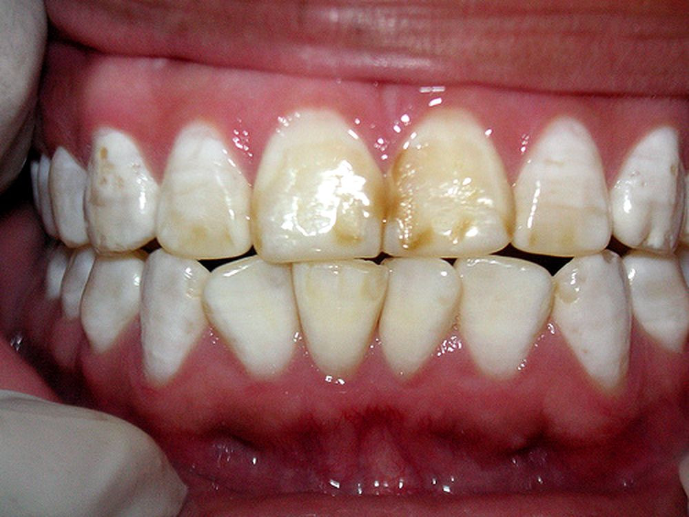¿Por qué mis dientes se manchan? Causas comunes