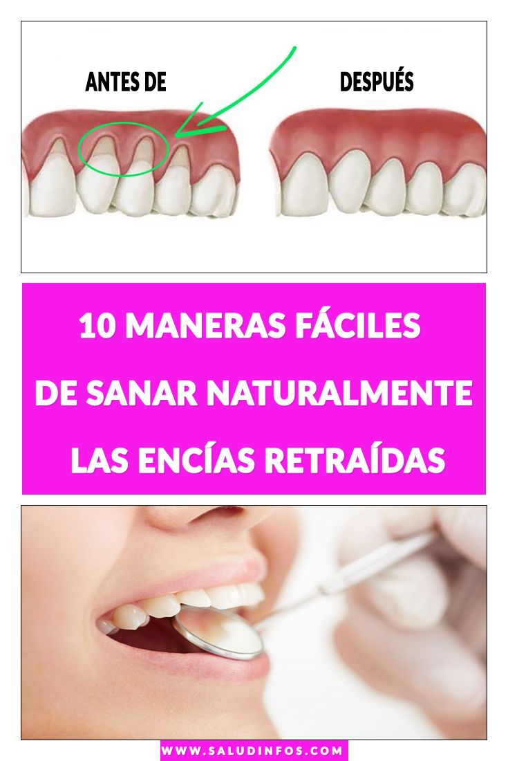 Guía Paso a Paso para el Cuidado Dental con Encías Retraídas