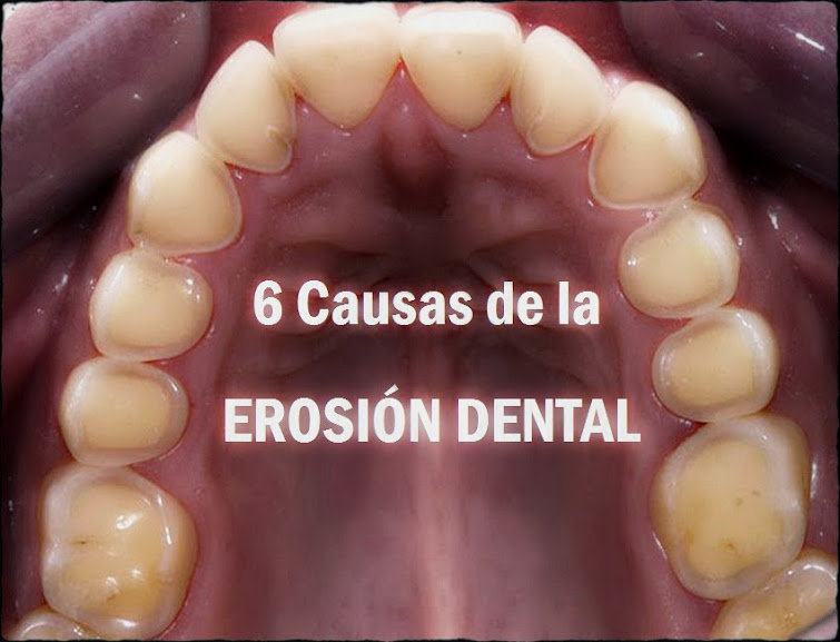 ¿Qué es la Erosión Dental y por qué es un Problema en Adolescentes?