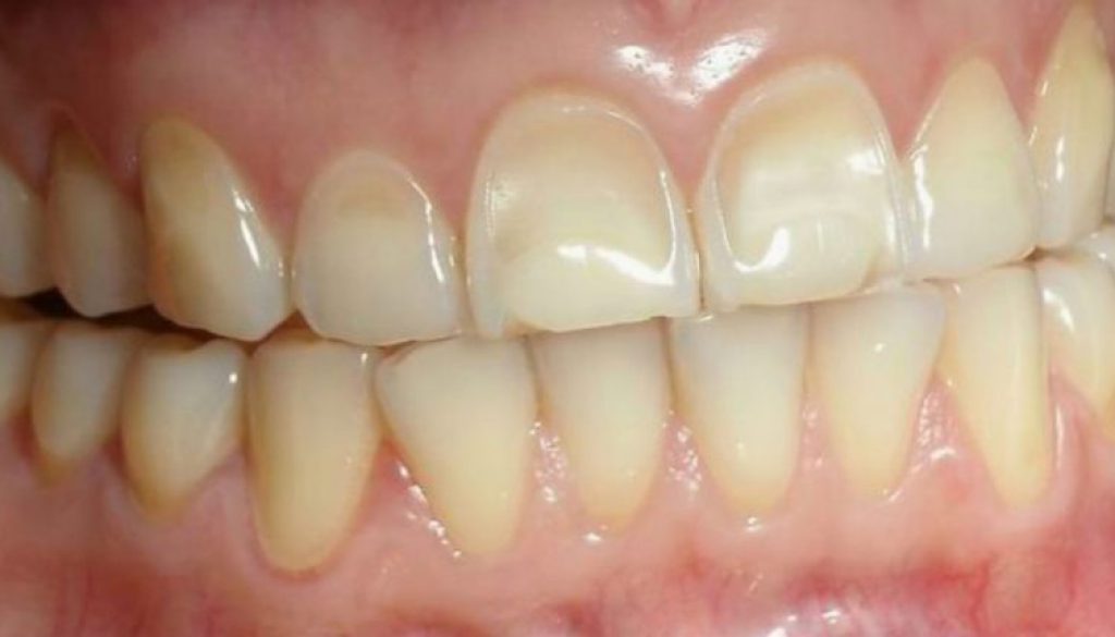 ¿Qué es la pérdida de esmalte y por qué es importante prevenirla?