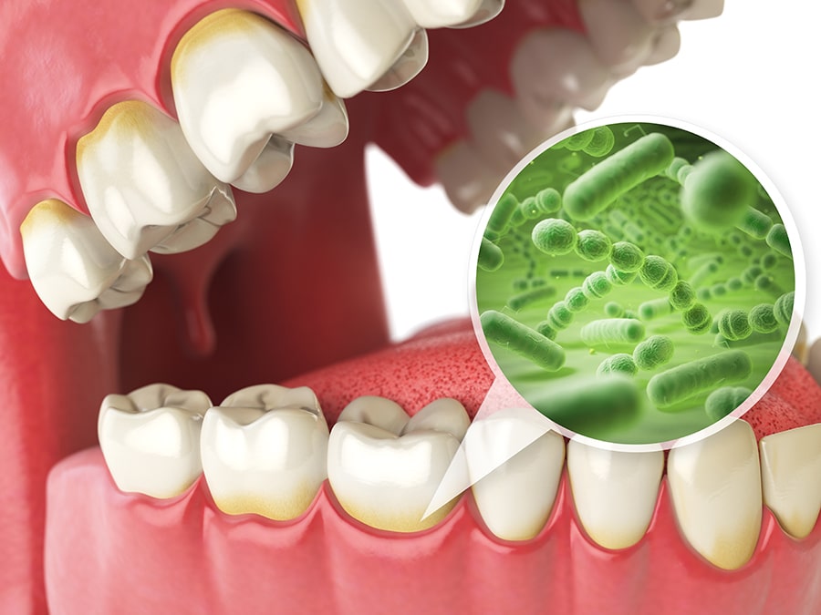 ¿Qué es la Placa Bacteriana y por qué es Importante Prevenirla?