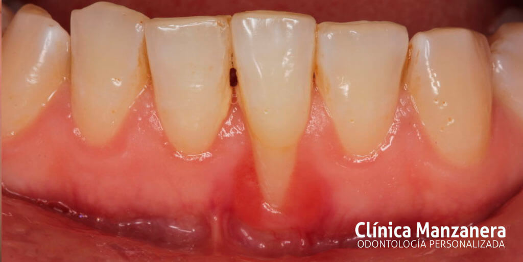 ¿Por qué se produce la inflamación después de una limpieza?