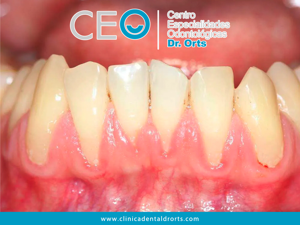 ¿Por qué una Mala Técnica de Cepillado Causa Retracción de Encías?