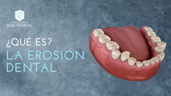 ¿Qué es la erosión dental y por qué los jugos cítricos son un problema?