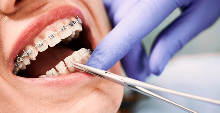 Clínica Dental Carlos Nespral brackets