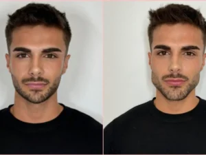 Masculinización facial antes que antes