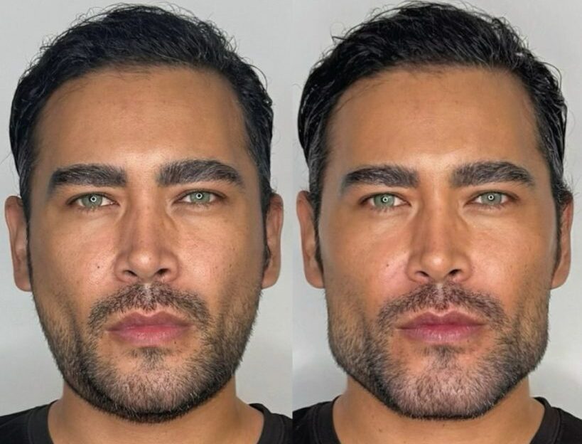 Masculinización facial