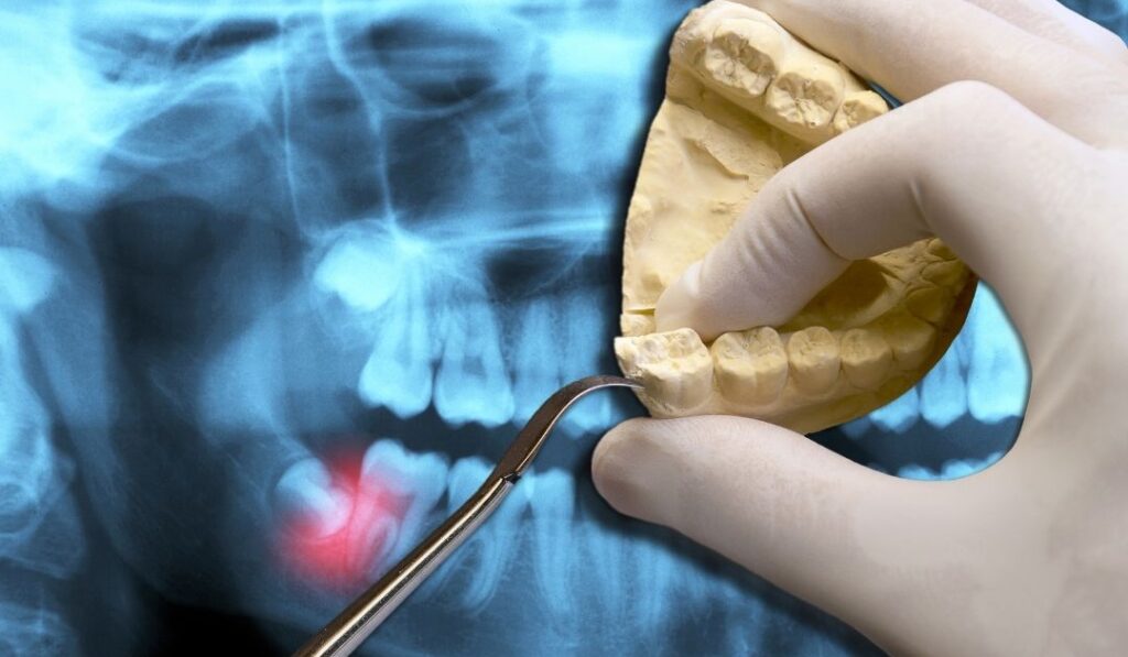 Cómo se extraen las muelas del juicio impactadas 3d