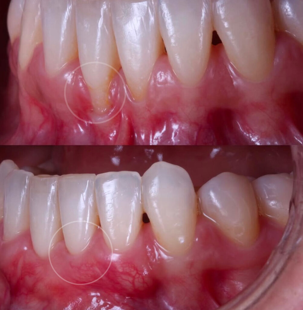 la gingivitis Qué es la recesión gingival antes despues