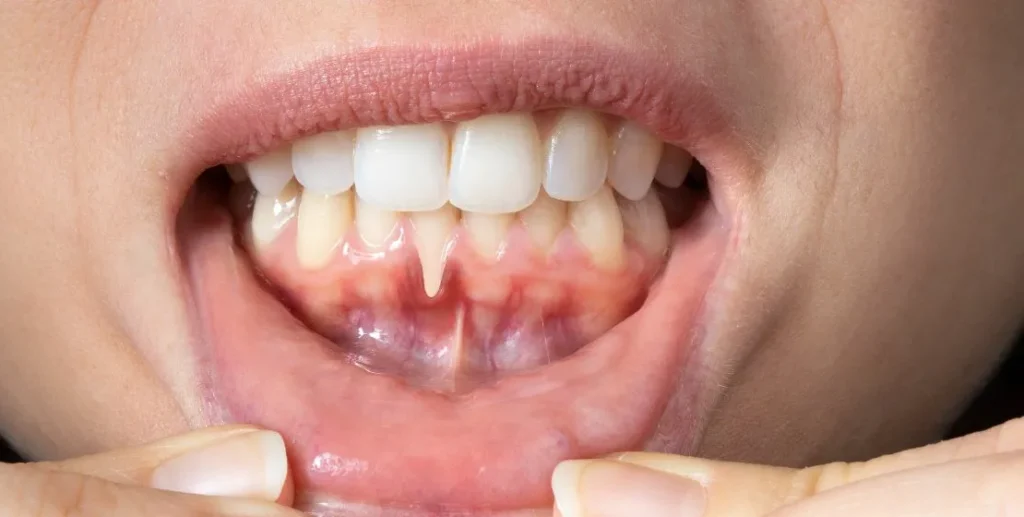 la gingivitis Qué es la recesión gingival dientes