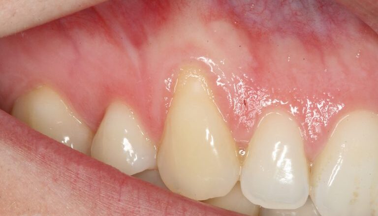 la gingivitis Qué es la recesión gingival encia