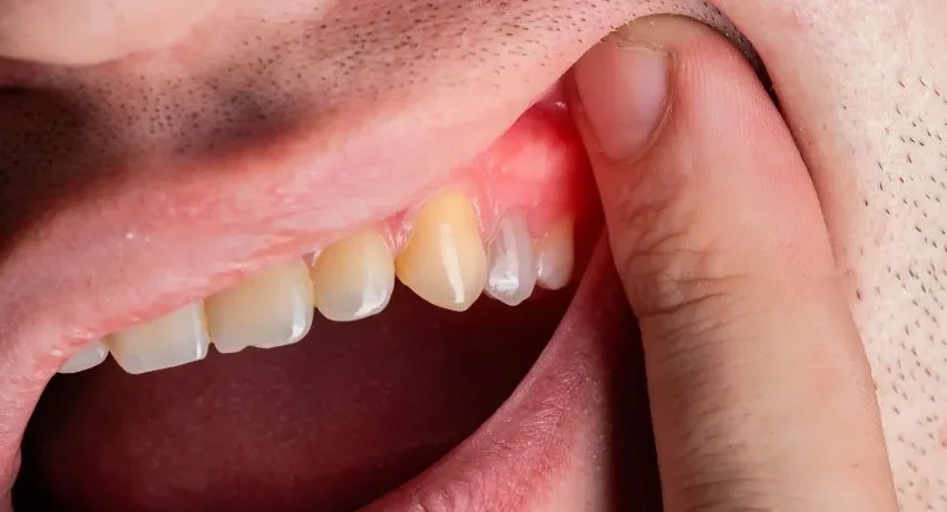 la gingivitis Qué es la recesión gingival labios